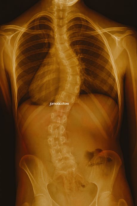 X-ray image of human torso with pronounced scoliosis curve