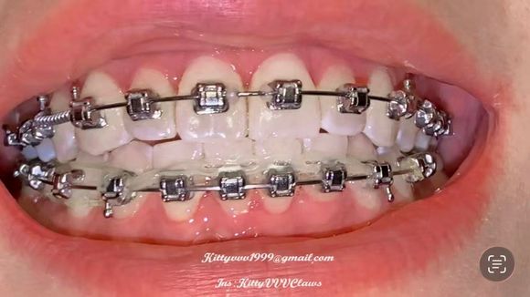 Close up of my braces, teeth and nails