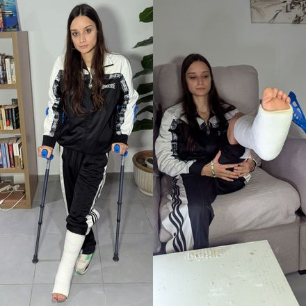 Real injury fresh SLC · indoor · swollen toes &amp; bruise · new cast 3/9 by Adri