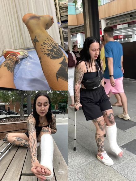 Real injury Plaster SLC street crutching by Mindarina   