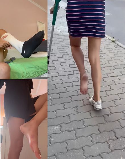 Real injury swollen &amp; bruise · barefoot public crutching · socks by Michela