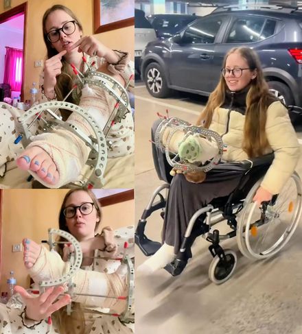 Real injury external fixator talking and mall wheelchair 