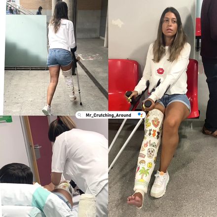 Real injury plaster CLC cast removal medical appointment crutching by Arana 