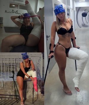 Youtuber broken leg 2/2 by Sofia