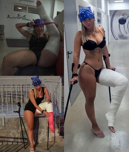 Youtuber broken leg 2/2 by Sofia