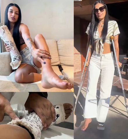 Real injury Cast removal · barefoot crutching · close-ups by Catalina 