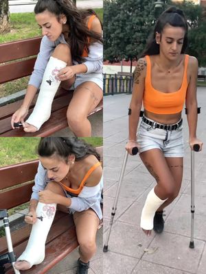 Real injury Plaster SLC street crutching and painting toenails by Apple