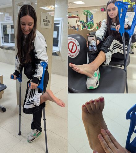 Real injury barefoot · cast off · swollen &amp; bruise · new cast 2/9 by Adri