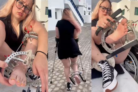 Real injury external fixator public crutching and close-ups