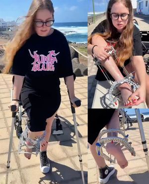 Real injury external fixator street crutching and close-ups