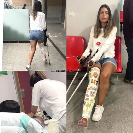 Real injury plaster CLC cast removal medical appointment crutching by Arana 