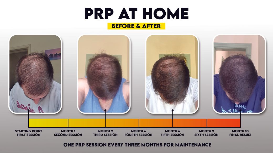prp at home