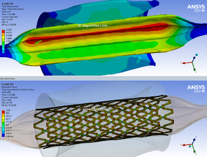 ANSYS Workbench 2021 R1 solved WBPZ archive with 3D model for Titanium Stent Trifold Balloon LS-DYNA