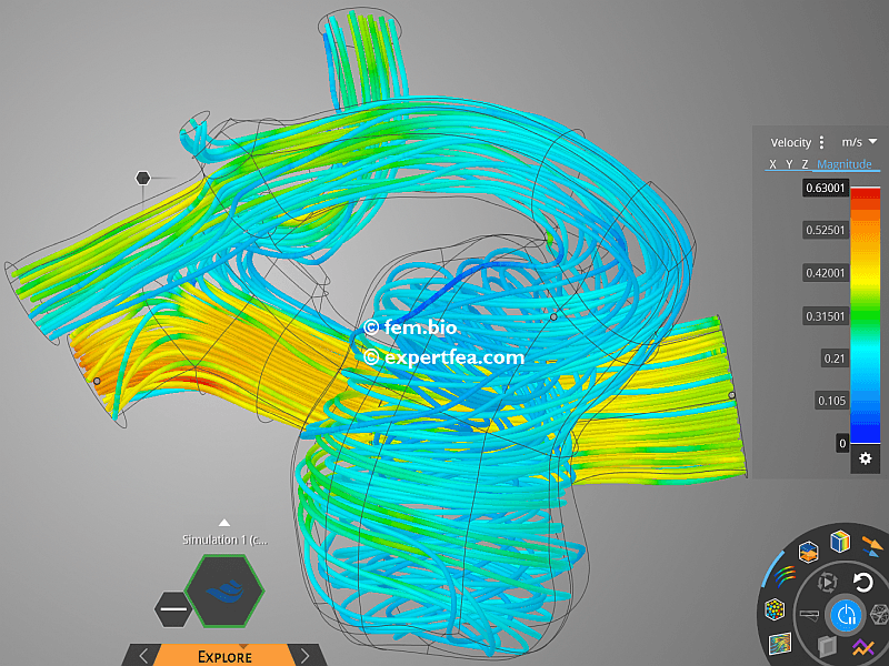 ANSYS Discovery LIVE 2021 R1 CFD simulation of the blood flow in an ...