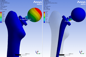 ANSYS Workbench 2022 R1 solved WBPZ archive with 3D model for Hip Replacement Fatigue of Implant