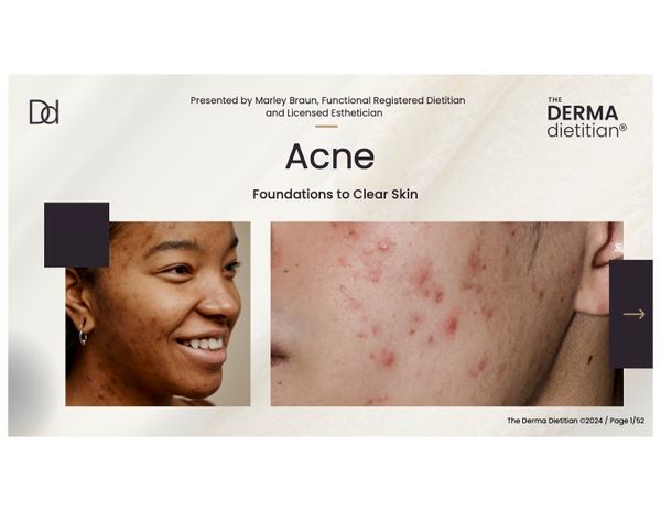 Acne Presentation